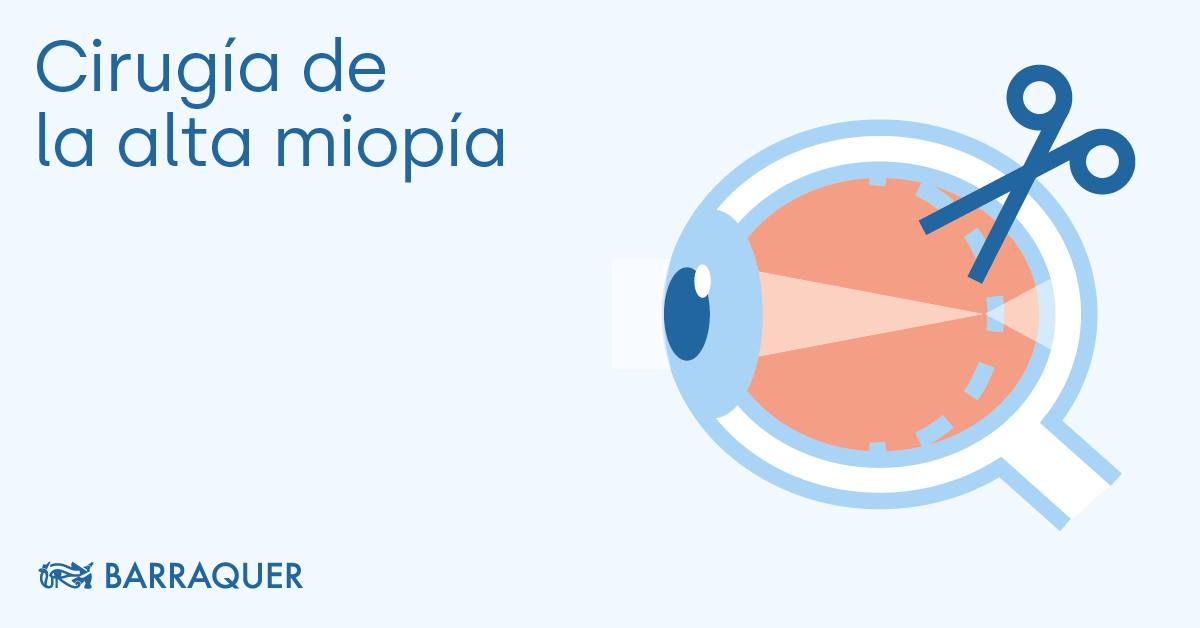 ▷ para Miopía | Cirugía - Barraquer
