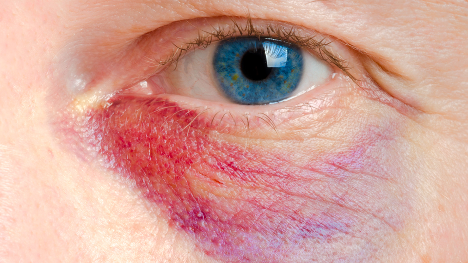 Ojo morado