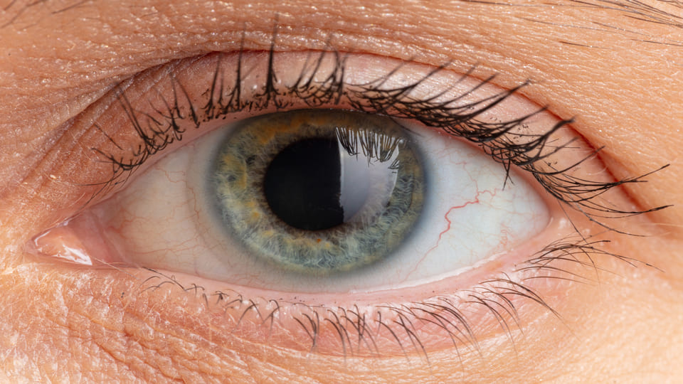 The Impact of Diabetes on Corneal Health