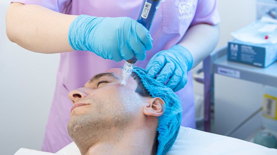 Microneedling