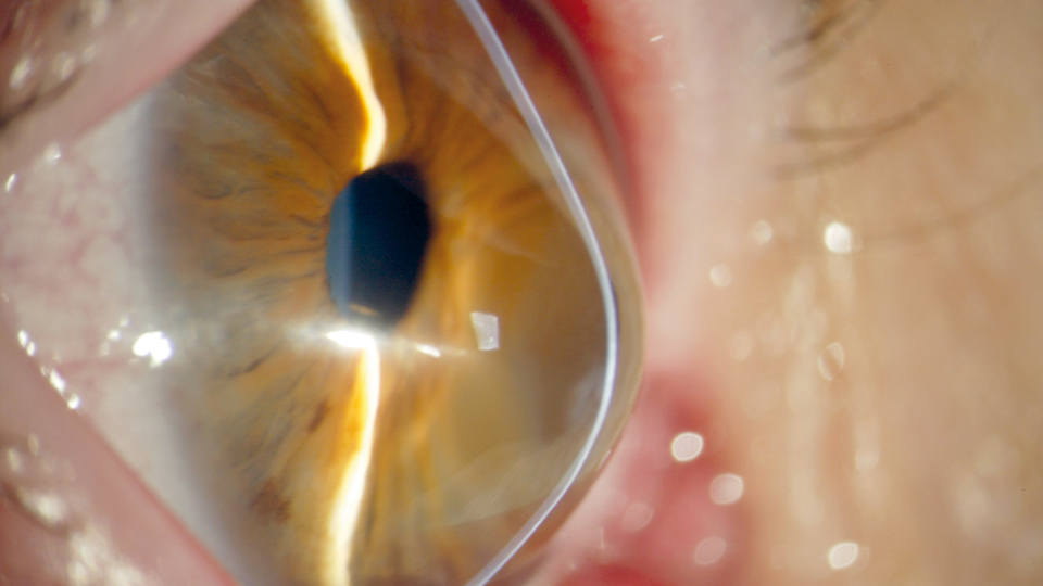 Astigmatismo irregular